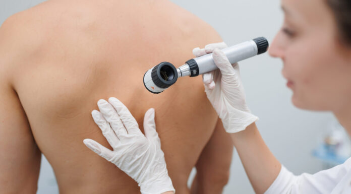 Особенности удаления невусов лазером в Виннице